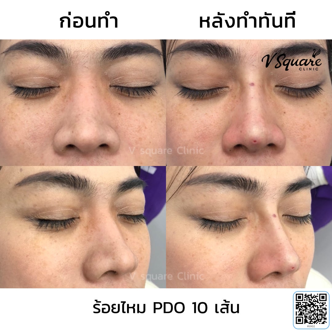 ร้อยไหมจมูกรีวิว_R0102