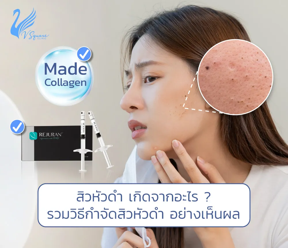 สิวหัวดำเกิดจากอะไร1000x860