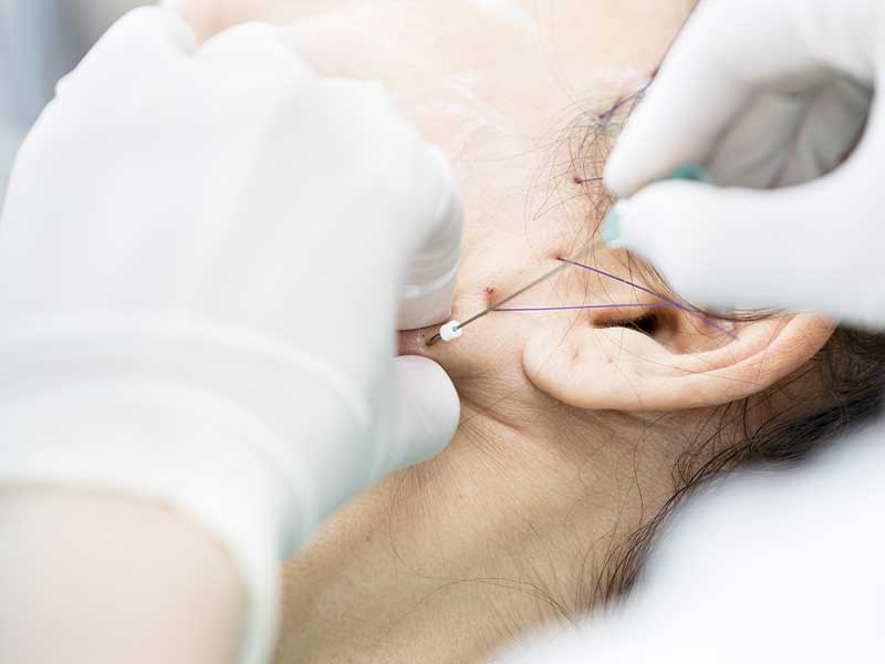 หลังร้อยไหม กี่วันเห็นผล