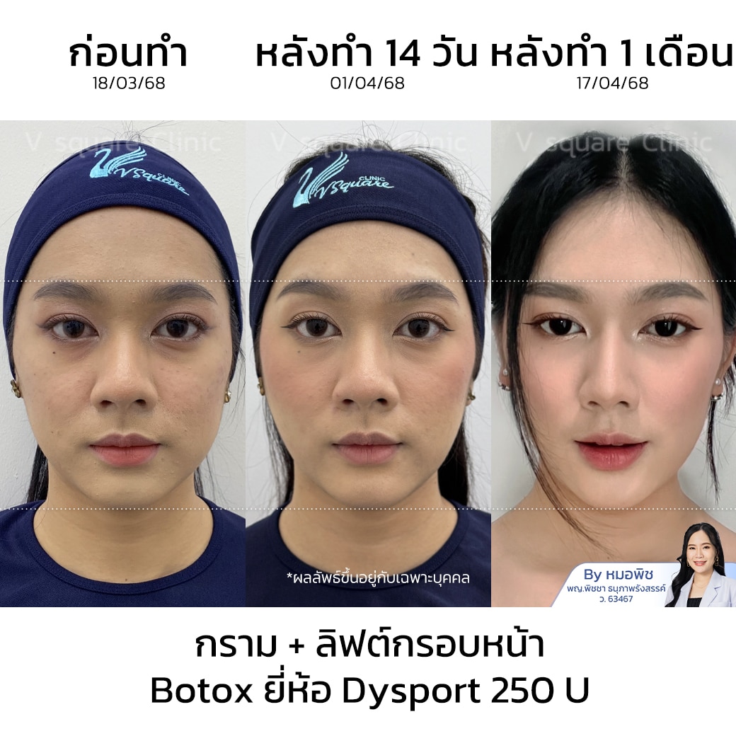 โบกราม ลิฟกรอบหน้า รีวิว_คุณยาหยี