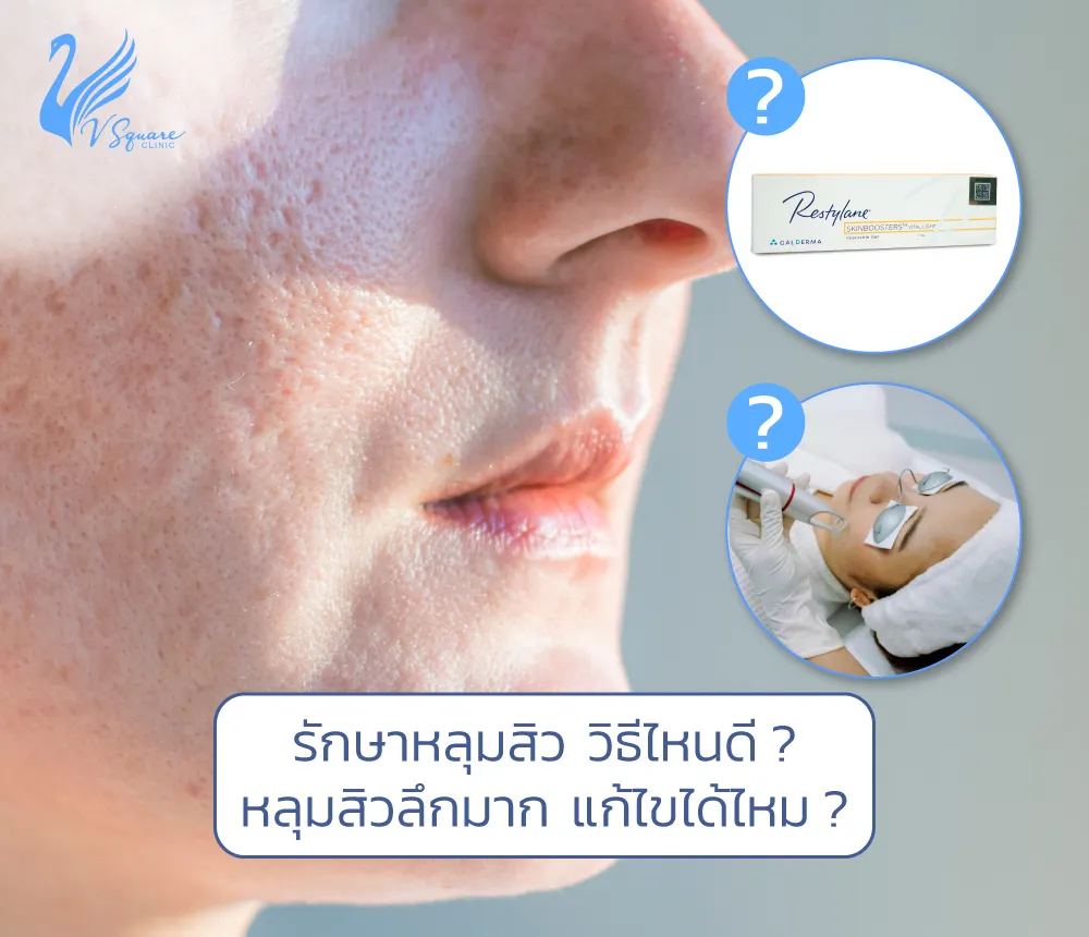 รักษาหลุมสิว วิธีไหนดี ? หลุมสิว มีกี่แบบ ? หลุมสิวลึกมาก กี่วันหาย ? รักษาหลุมสิว วิธีไหนดี ? หลุมสิว มีกี่แบบ ? หลุมสิวลึกมาก กี่วันหาย ?