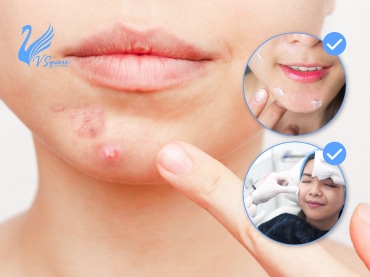 สิวที่คาง เกิดจากอะไร ? เคลียร์ปัญหาสิวที่คางให้หายขาด วิธีไหนดี ? สิวที่คาง เกิดจากอะไร ? เคลียร์ปัญหาสิวที่คางให้หายขาด วิธีไหนดี ?