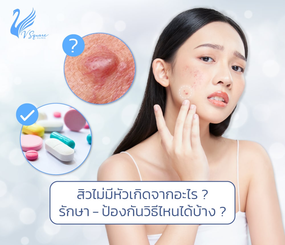 สิวไม่มีหัว นูน ๆ เกิดจากสาเหตุใด รักษาอย่างไร ป้องกันดูแลวิธีไหนดี