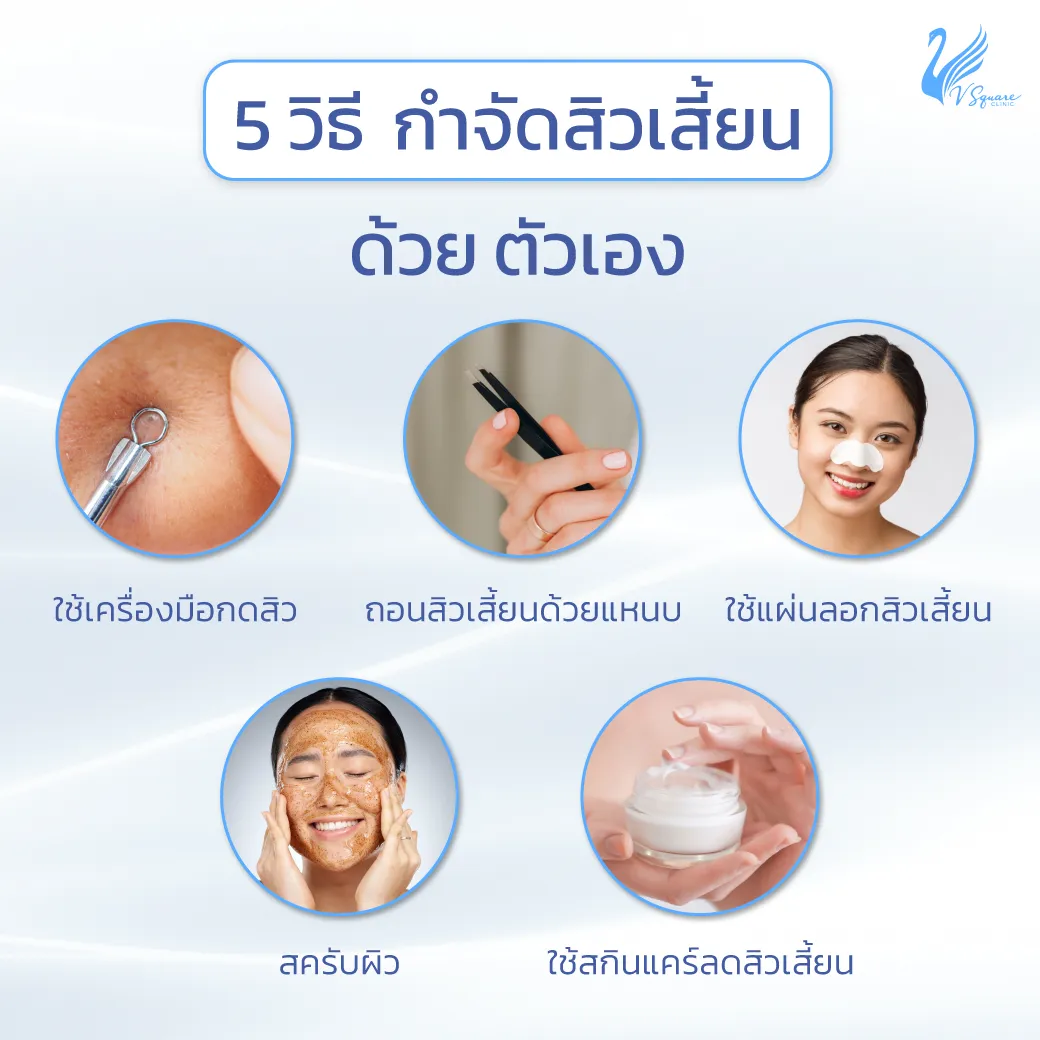 AW_5-วิธีกำจัดสิวเสี้ยนด้วยตัวเอง