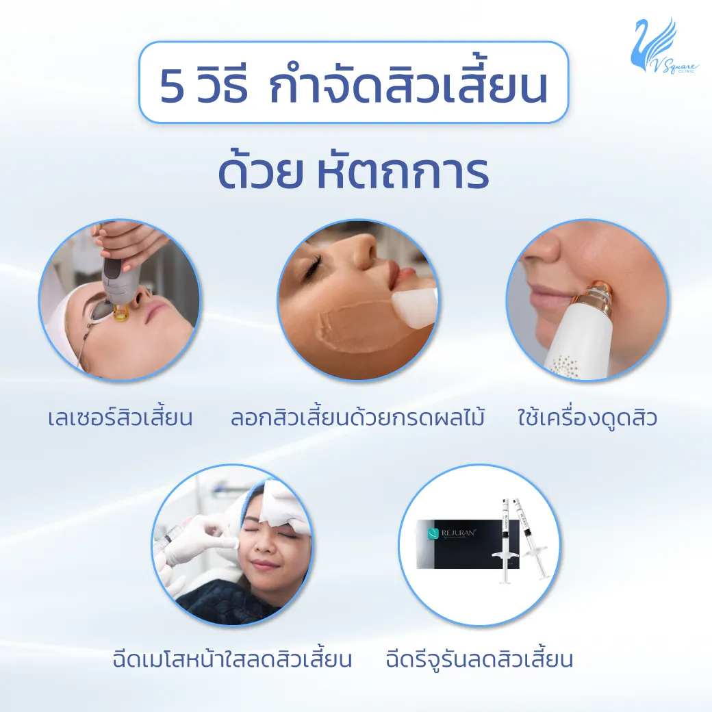 AW_5-วิธีกำจัดสิวเสี้ยนด้วยหัตถการ