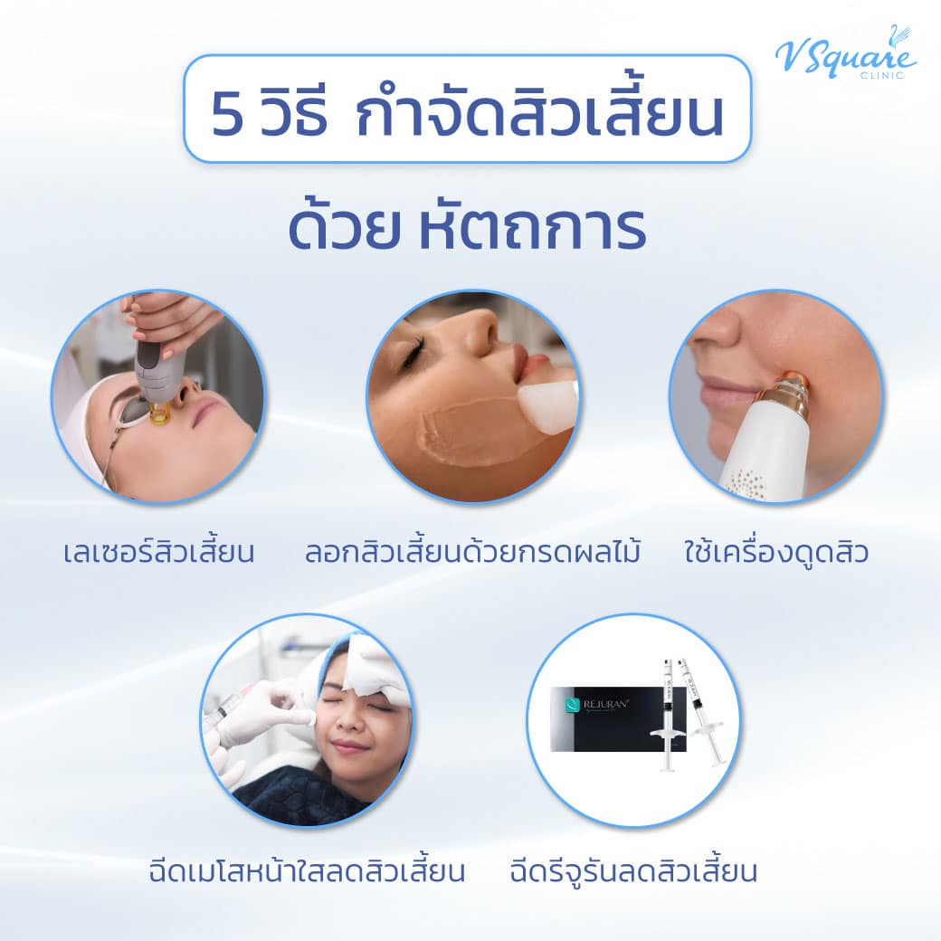 กำจัดสิวเสี้ยนด้วยหัตถการ