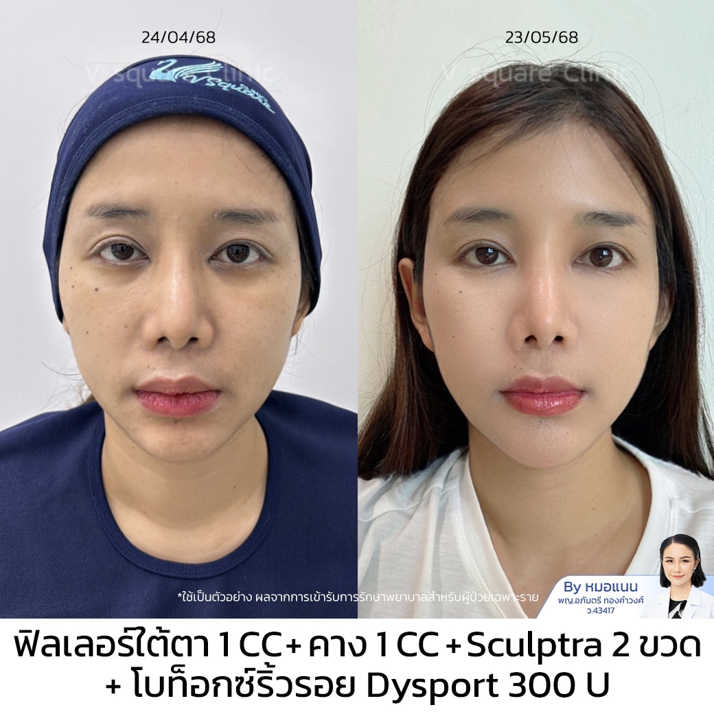 ฉีดฟิลเลอร์ใต้ตา ที่ไหนดี รีวิว