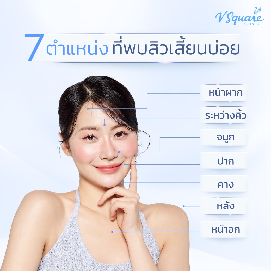 ตำแหน่งสิวเสี้ยน