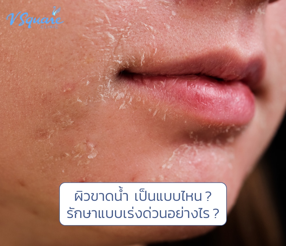 ผิวขาดน้ำ