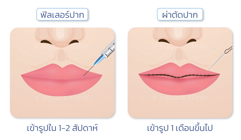 ฟิลเลอร์ปากกับการผ่าตัดปาก