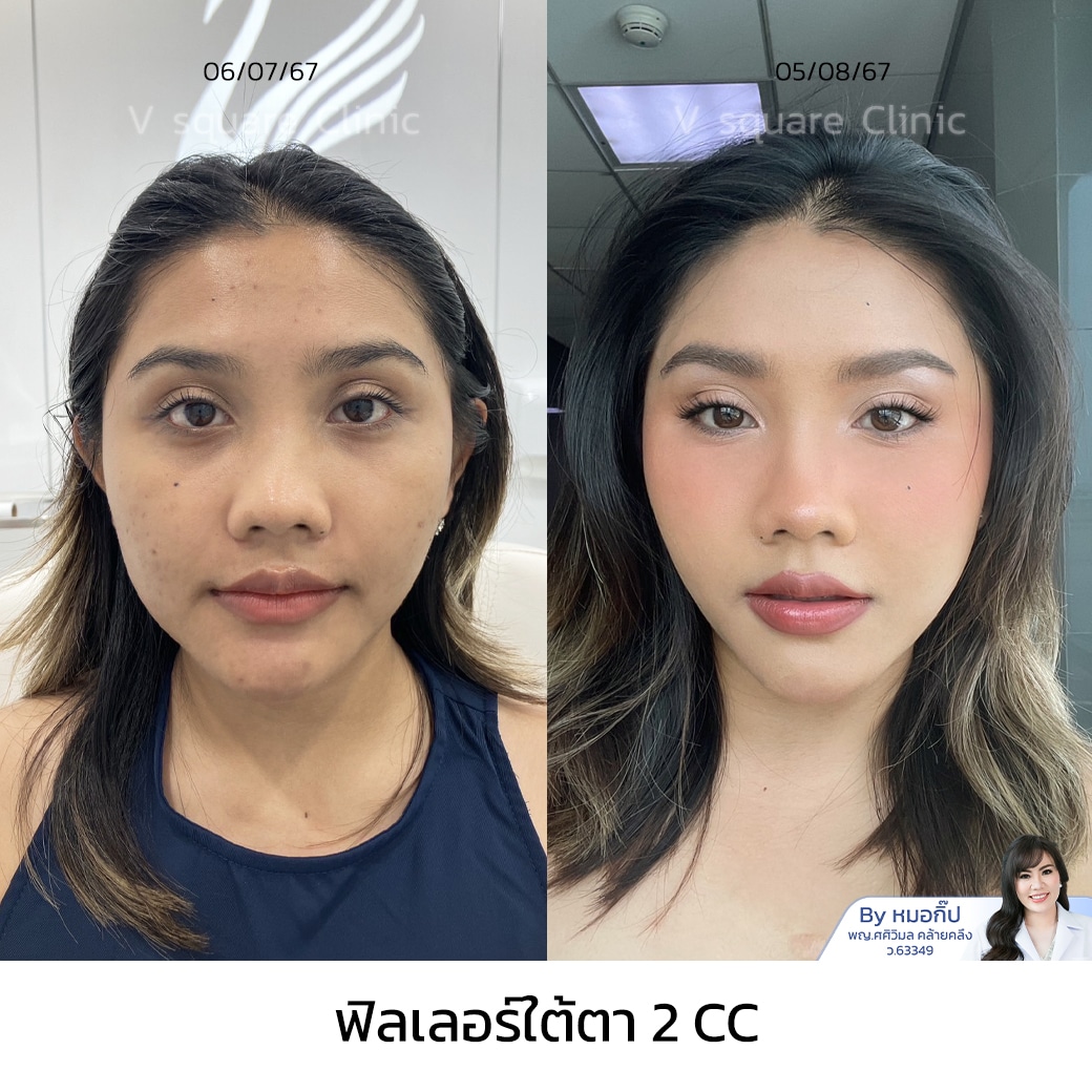 ฟิลเลอร์ใต้ตา รีวิว