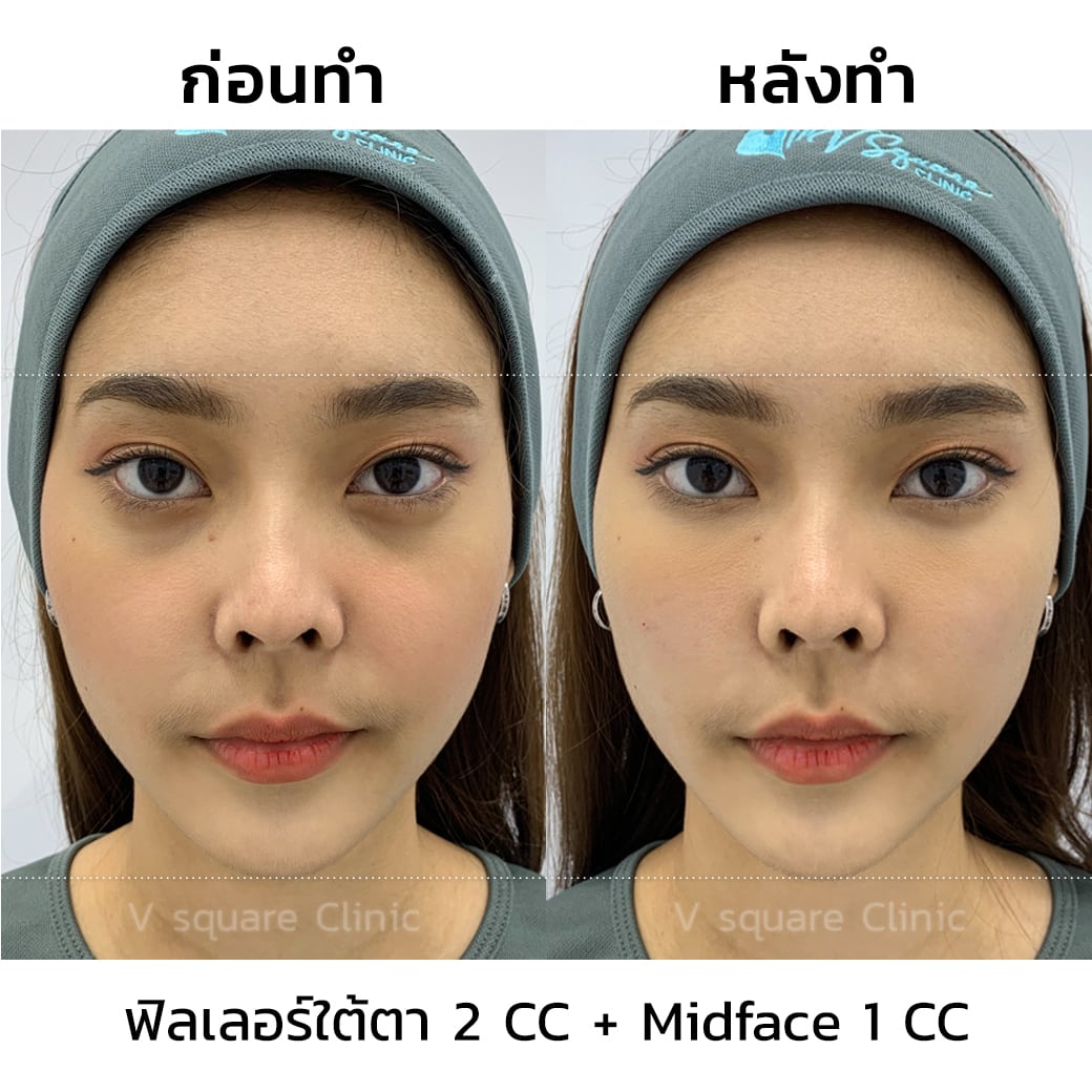 รีวิว ฉีดฟิลเลอร์ใต้ตา 2 CC