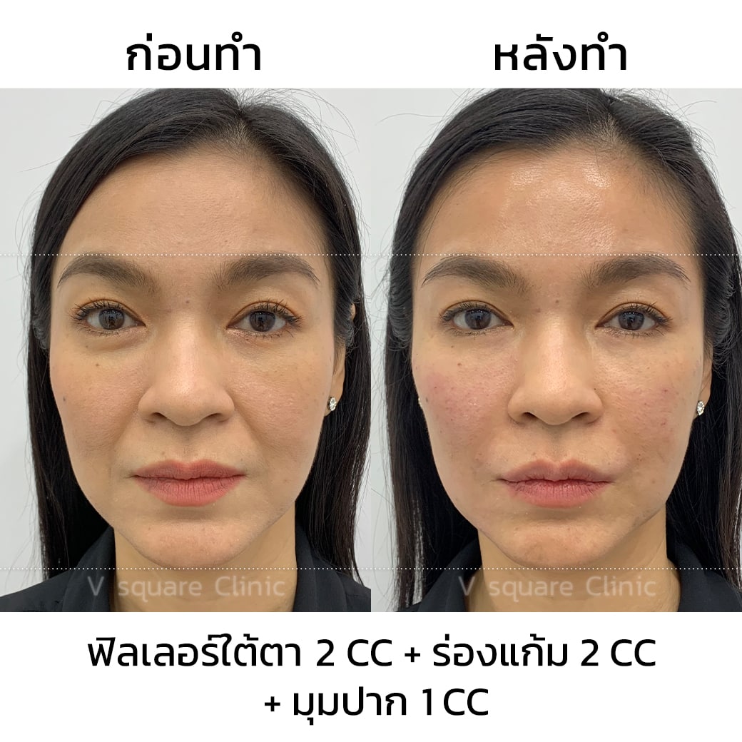 รีวิว ฉีดฟิลเลอร์ใต้ตา 2 CC(1)