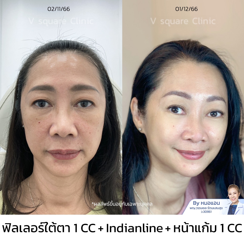 รีวิวฉีดฟิลเลอร์ใต้ตา ที่ไหนดี