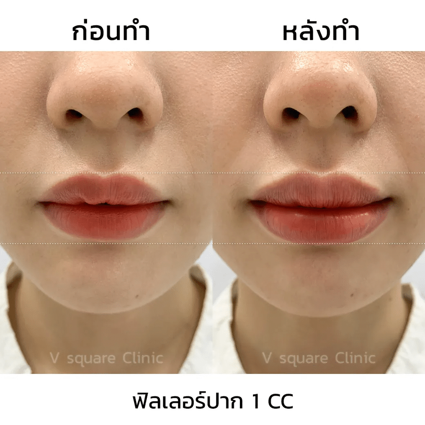 รีวิวฟิลเลอร์ปาก