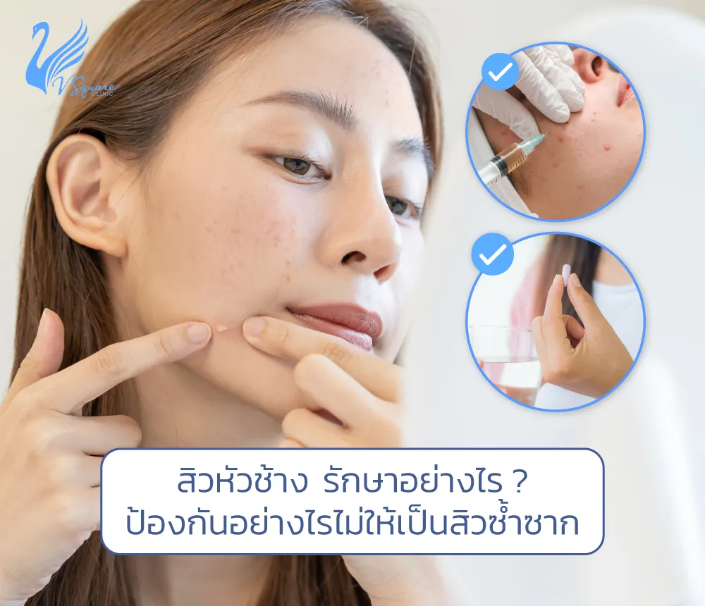 สิวหัวช้างรักษาอย่างไร1000x860