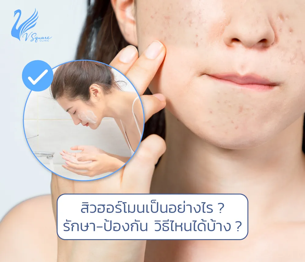 สิวฮอร์โมนเป็นอย่างไร1000x860