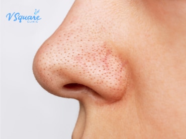 สิวเสี้ยน 370x277