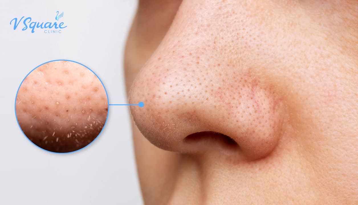 สิวเสี้ยน คืออะไร มีลักษณะอย่างไร