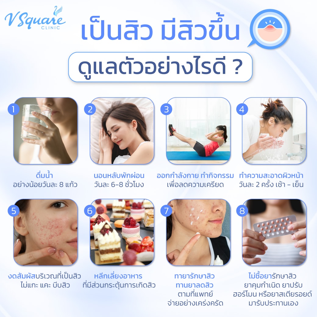 สิวเสี้ยน ดูแลตัวเอง