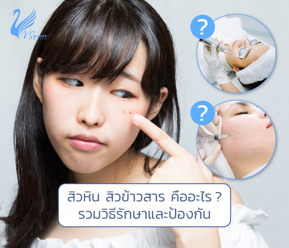 สิวหิน สิวข้าวสาร คืออะไร แตกต่างกันไหม ? รักษาและป้องกันอย่างไรได้บ้าง สิวหิน สิวข้าวสาร คืออะไร แตกต่างกันไหม ? รักษาและป้องกันอย่างไรได้บ้าง