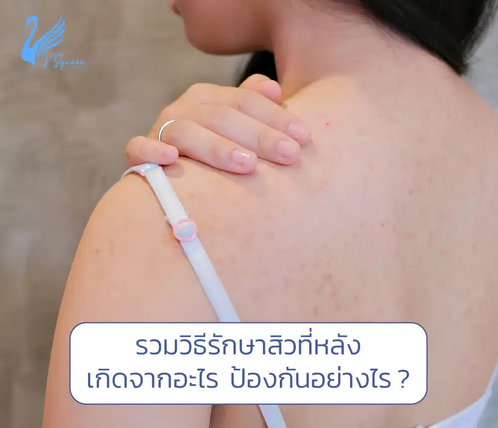 รวมวิธีรักษาสิวที่หลังเกิดจากอะไร