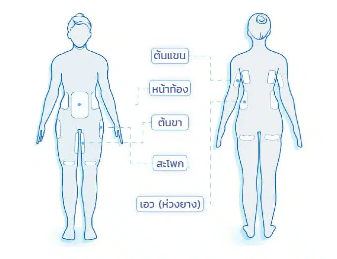 CoolSculpting ลดต้นขา