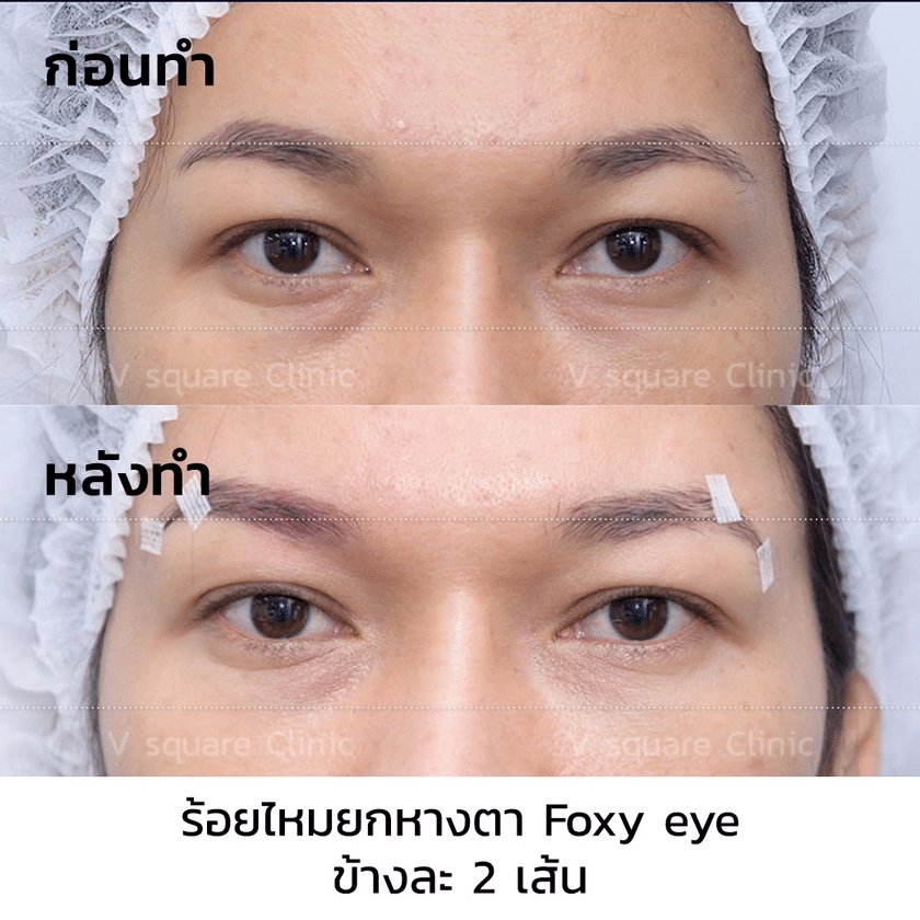 รีวิว ร้อยไหมยกหางตา Foxy Eyes