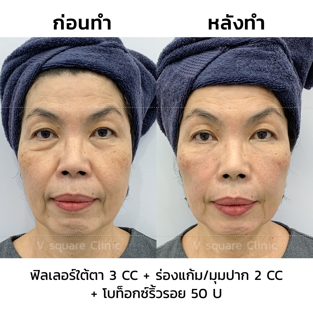 รีวิวฉีดฟิลเลอร์กับโบท็อก