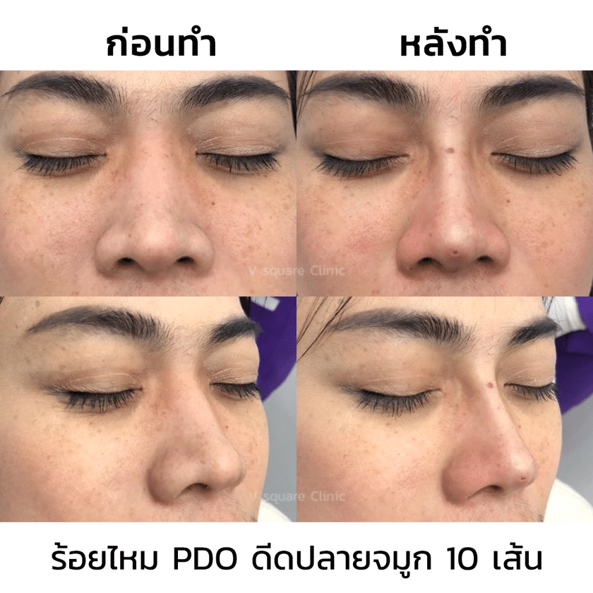 รีวิวร้อยไหมจมูก