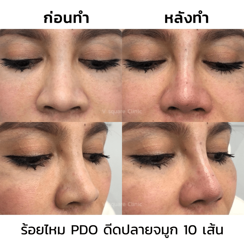 รีวิวร้อยไหมจมูก(1)