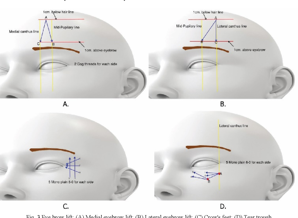 ร้อยไหมบริเวณใต้ตา