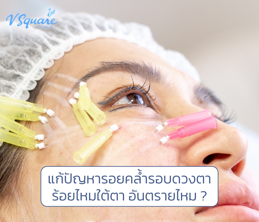 ร้อยไหมใต้ตา