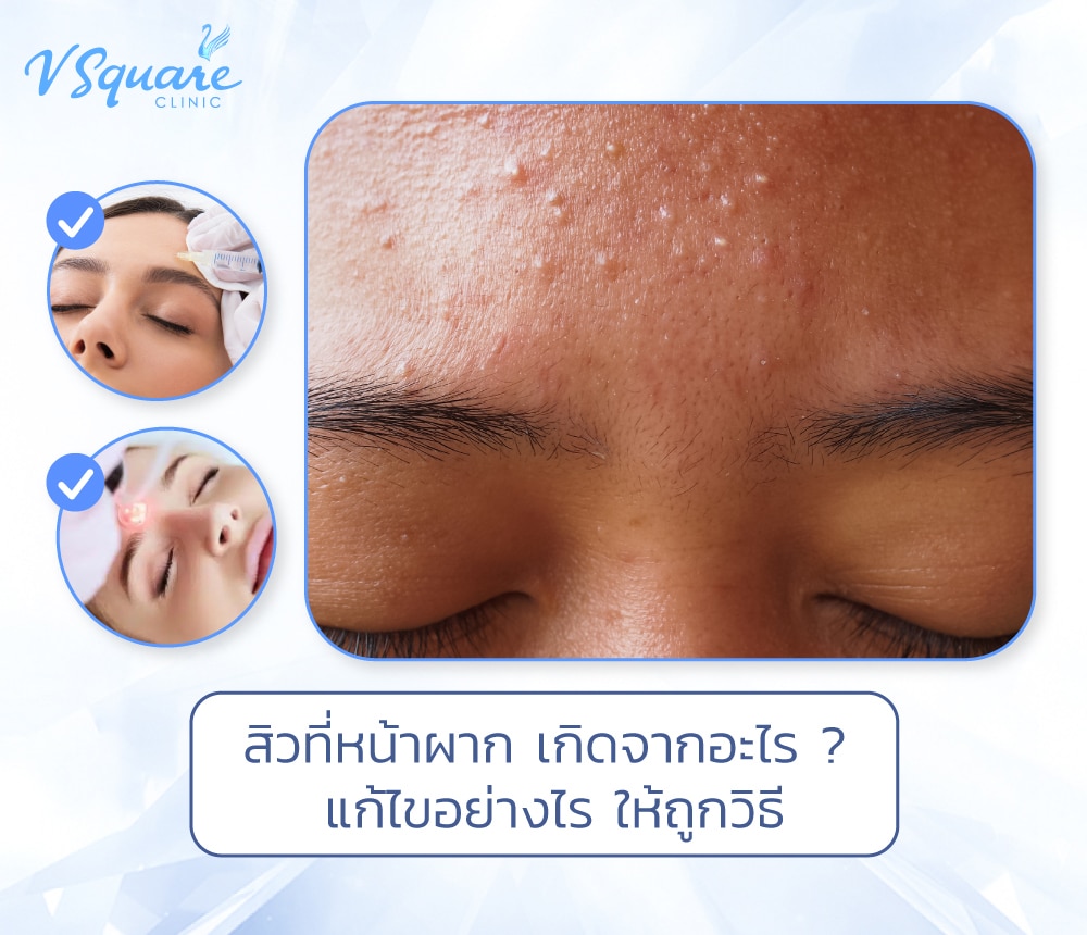 สิวที่หน้าผาก