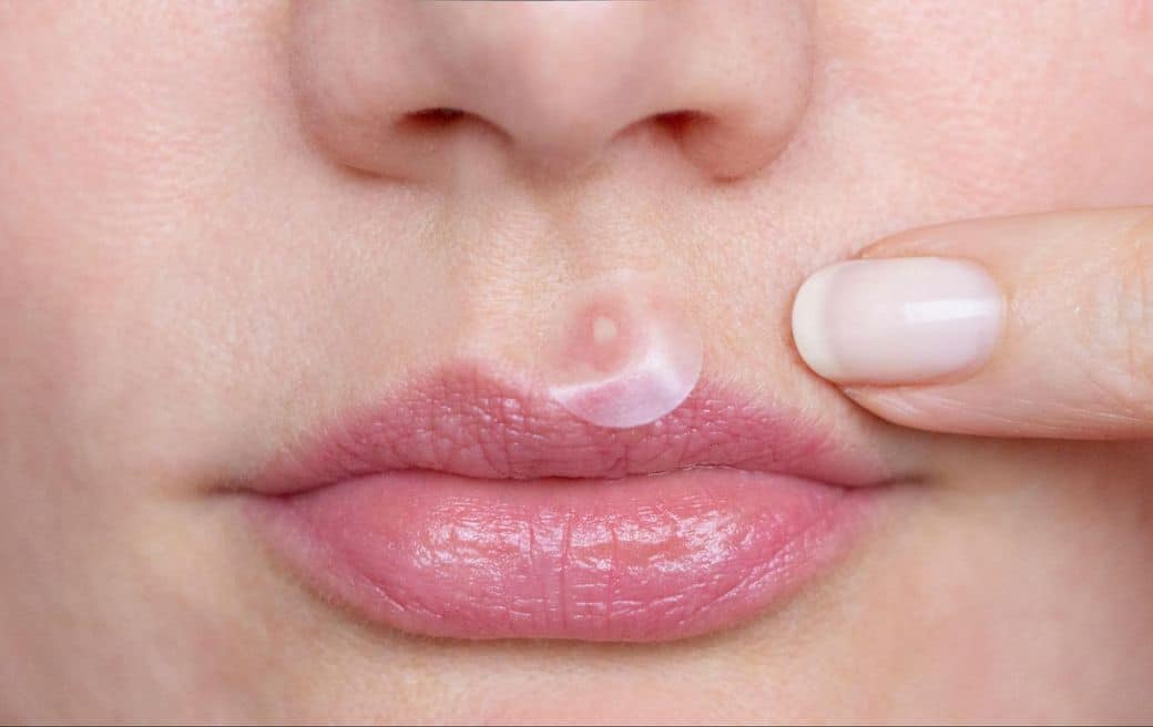 สิวที่ปาก สิวขึ้นรอบปาก มุมปาก เกิดจากอะไร ? รักษาด้วยวิธีไหนได้บ้าง ?