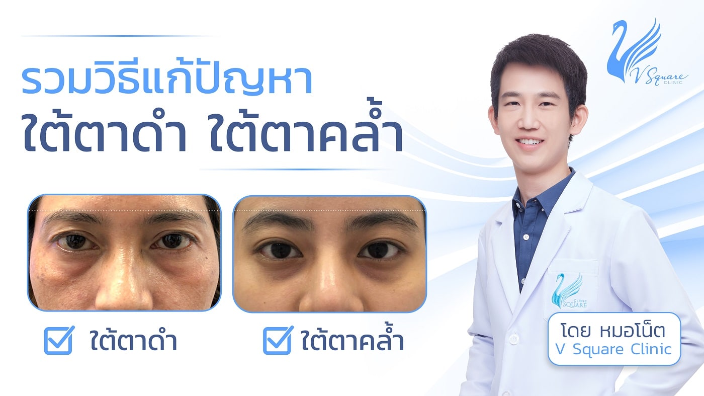 ฉีดฟิลเลอร์ใต้ตา แก้ปัญหาร่องใต้ตา ถุงใต้ตา ลดริ้วรอย ปลอดภัย เห็นผลชัดเจน