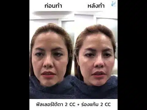 รีวิวฟิลเลอร์ใต้ตา แก้ปัญหาความหย่อนคล้อย ลดถุงใต้ตา ตาคล้ำ