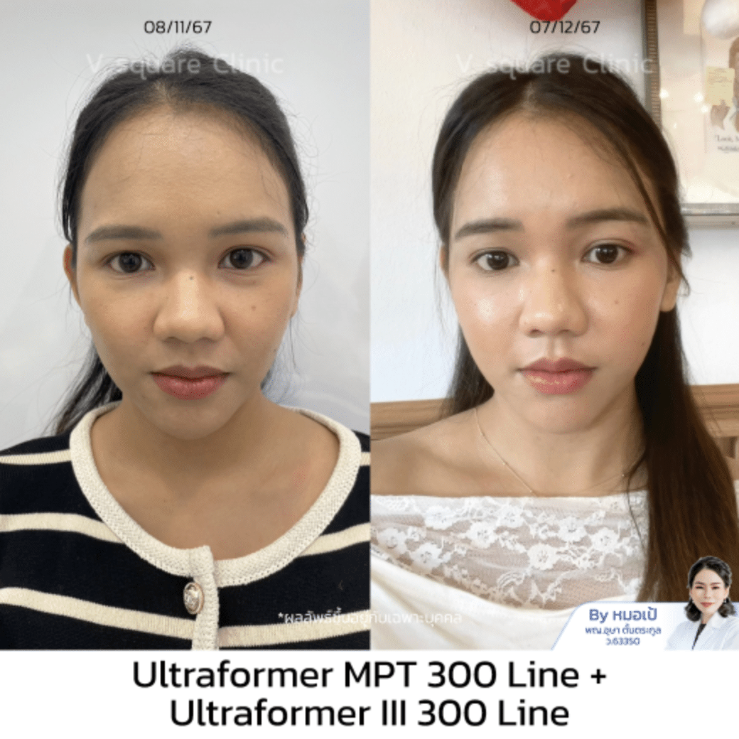 รีวิว Hifu ยกใบหน้า_มายด์