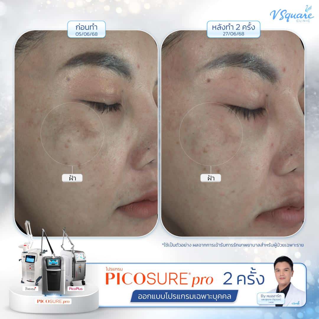 รีวิว Pico Laser ก่อน-หลังทำ