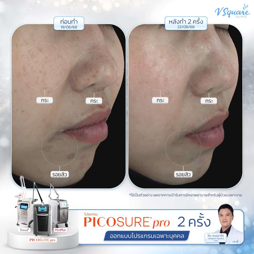 รีวิว Pico Laser ก่อน-หลังทำ