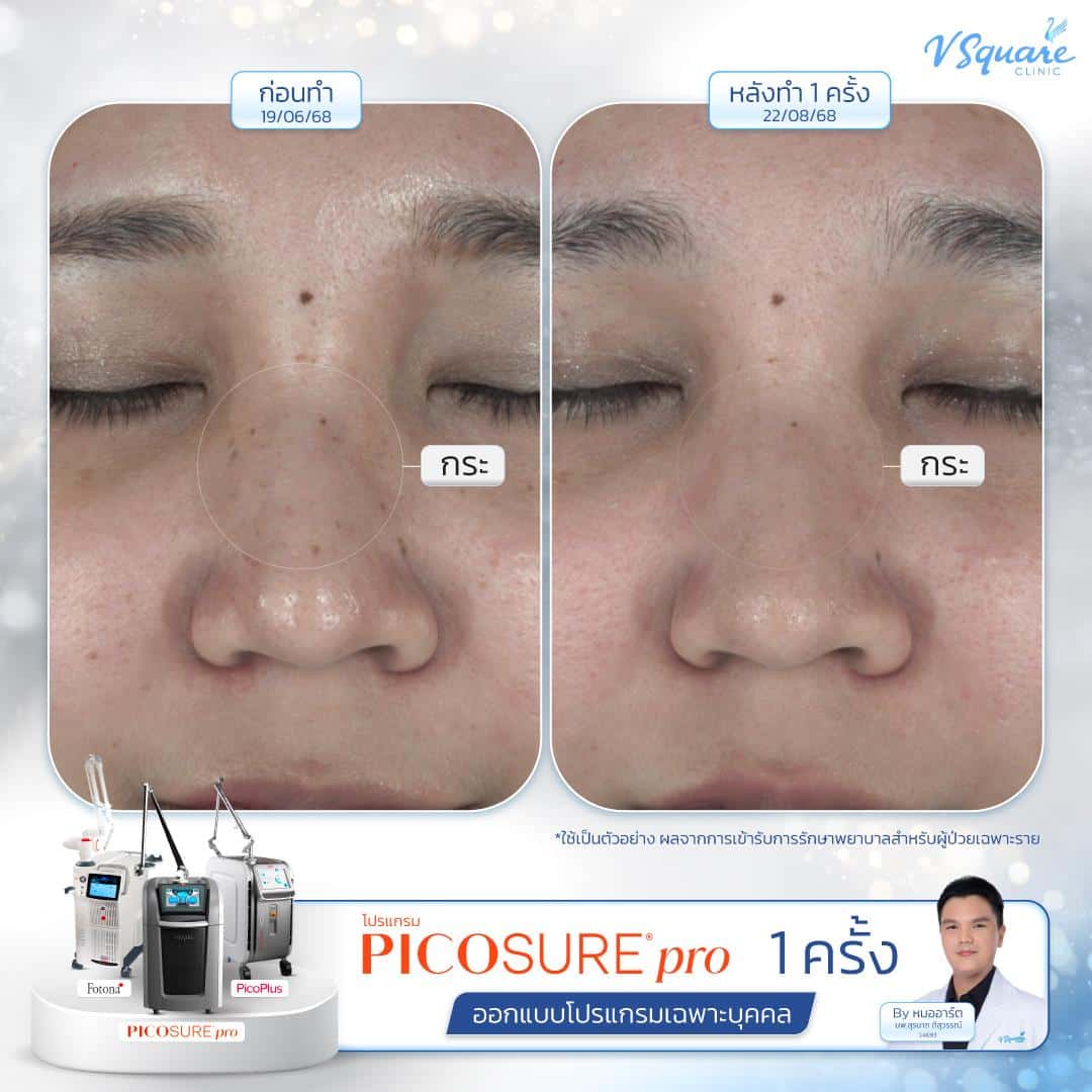 รีวิว Pico Laser ก่อน-หลังทำ(4)