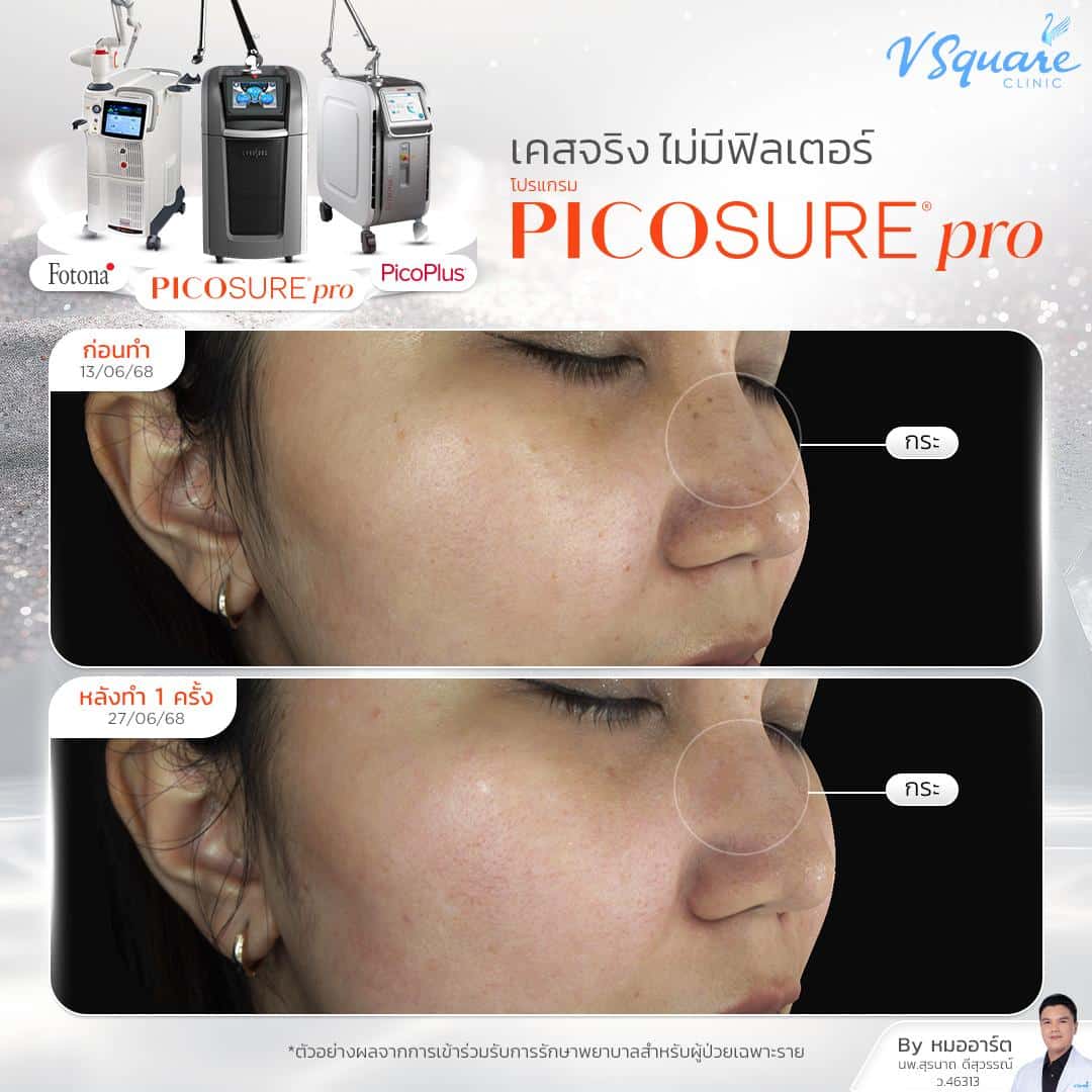 รีวิว Pico Laser ก่อน-หลังทำ(7)