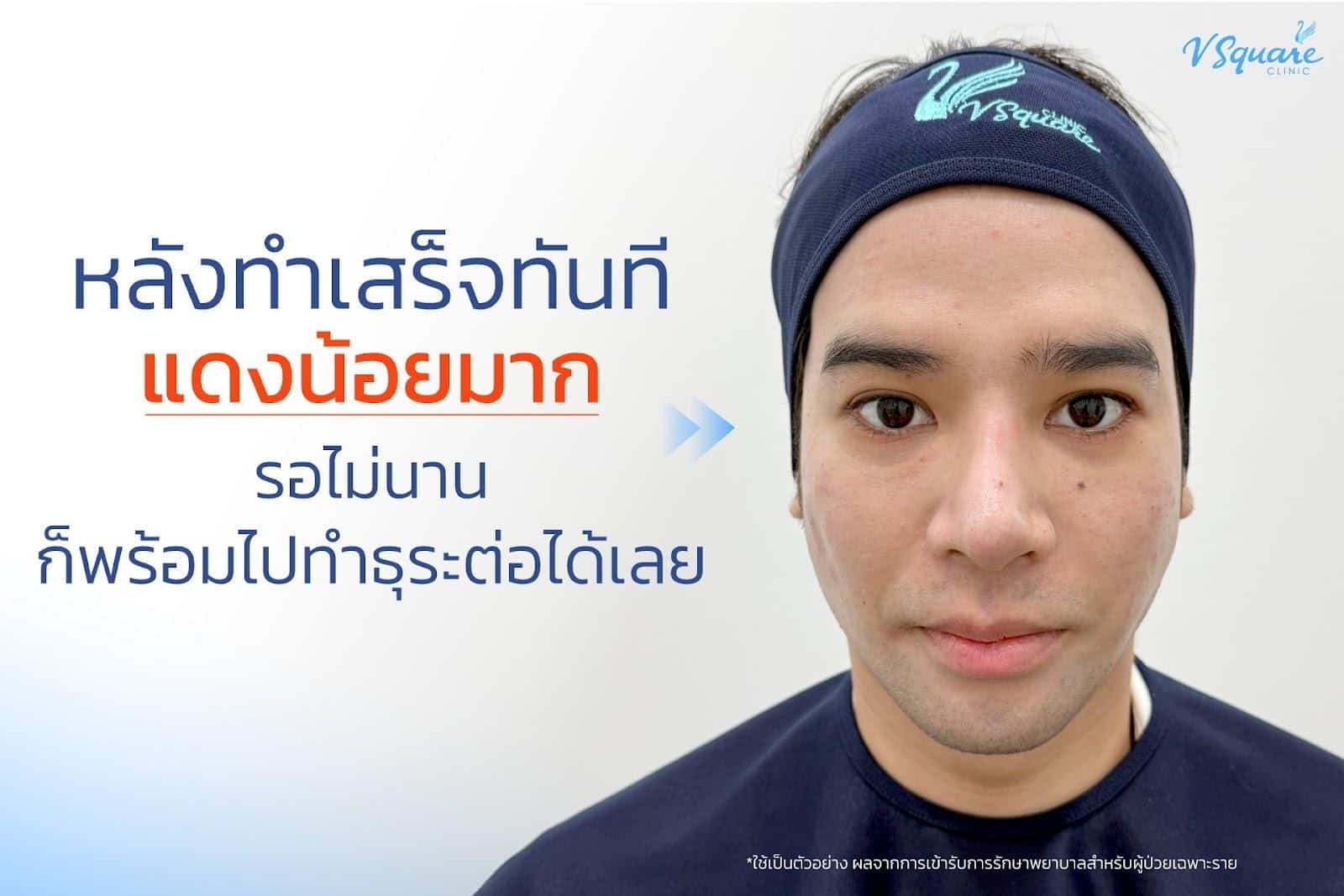 รีวิว Pico Laser หลังทำ(1)