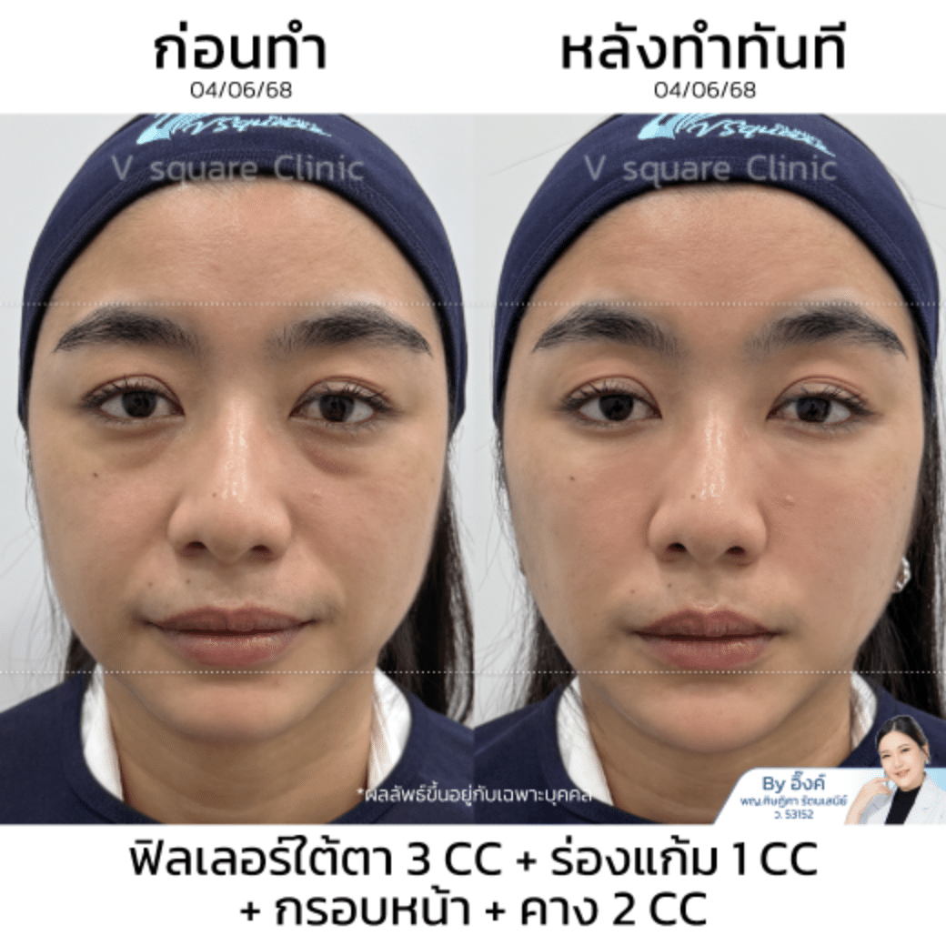 รีวิวฉีดฟิลเลอร์ยกกระชับใบหน้า_คุณอิ้งค์ (แบบเบสๆ)