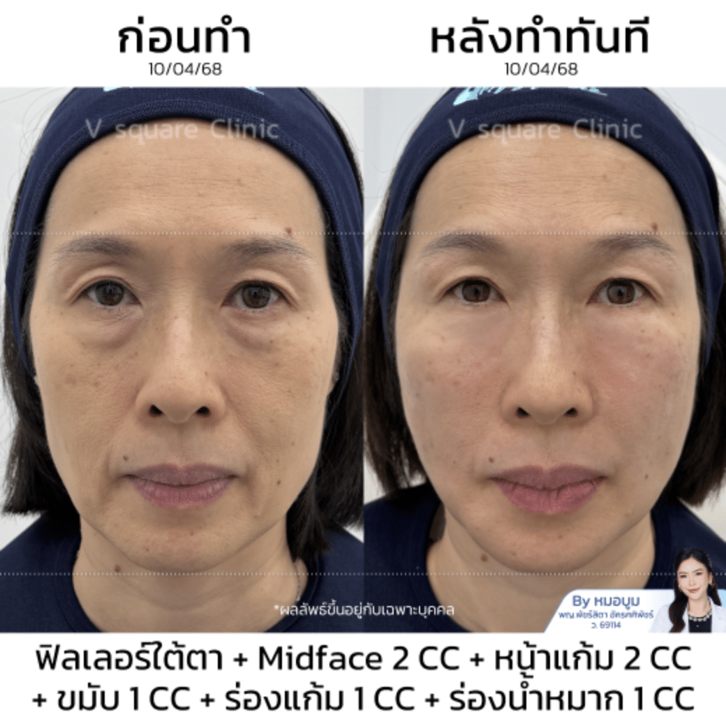 รีวิวฉีดยกกระชับใบหน้า_คุณพลอย (แบบเบสๆ)