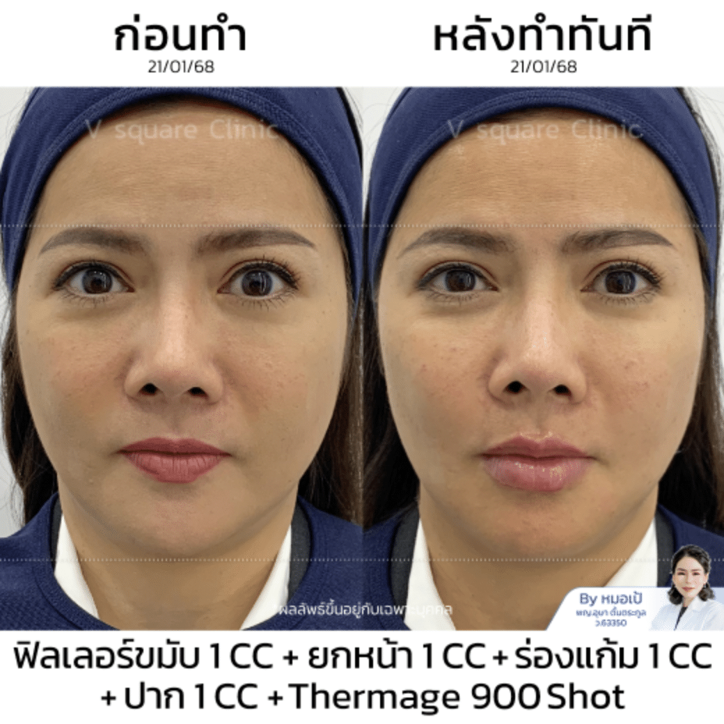 รีวิวฉีดยกกระชับใบหน้า_พี่ปุ้ย (Content โหนกระแส)
