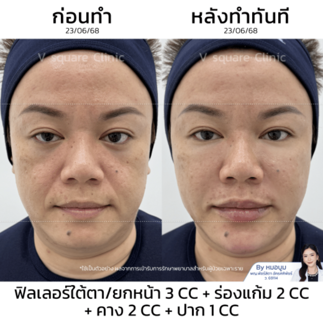 รีวิวฟิลเลอร์ยกกระชับใบหน้า_ คุณปาย (แบบเบสๆ)
