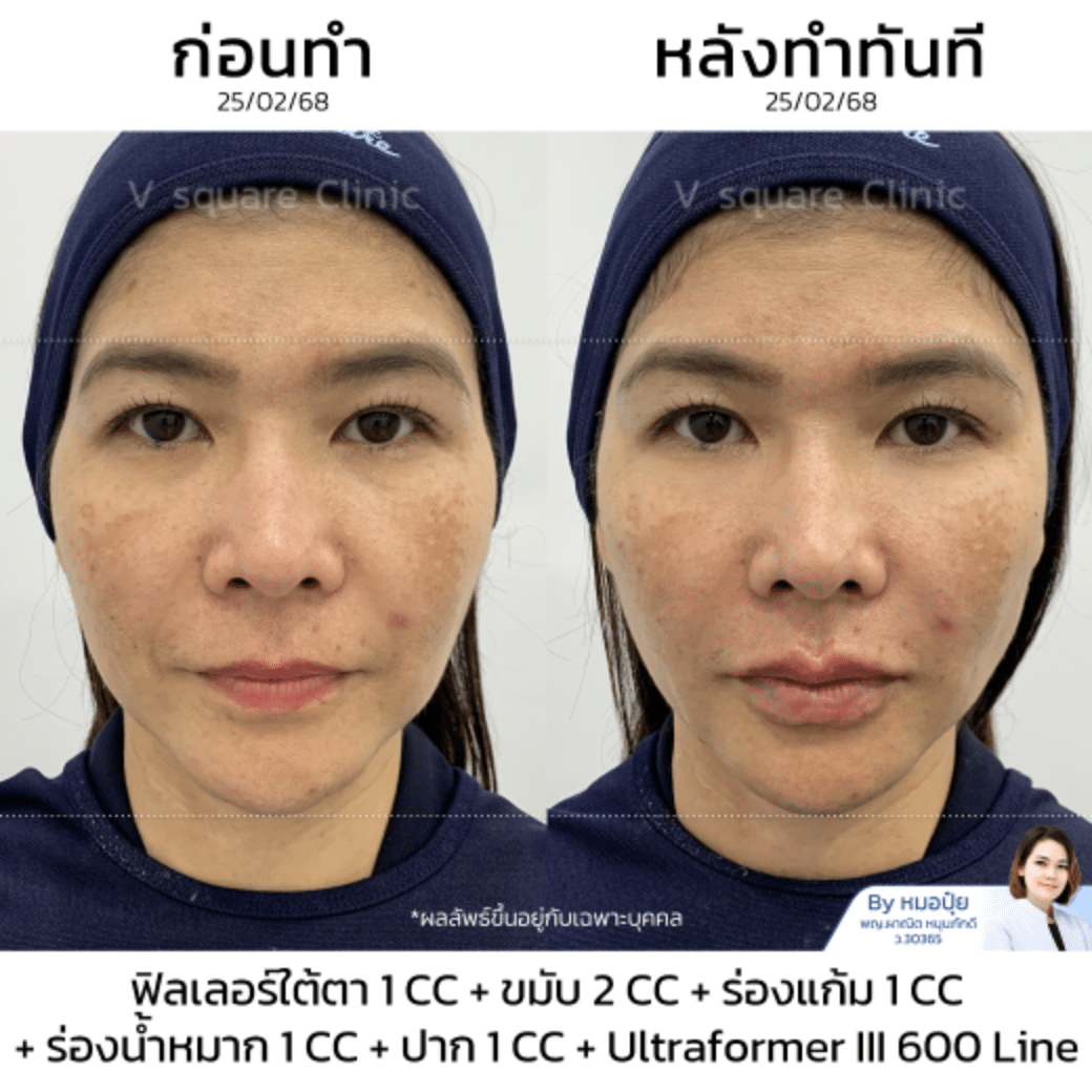 รีวิวฟิลเลอร์ยกกระชับใบหน้า_คุณหมวยฃ