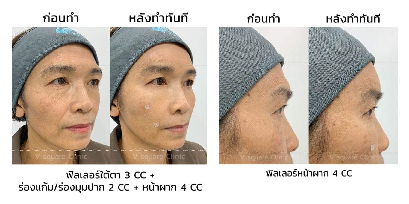 รีวิวฟิลเลอร์หน้าผาก_คุณนุช
