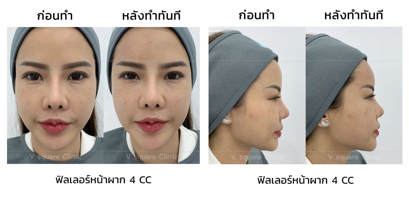 รีวิวฟิลเลอร์หน้าผาก_คุณปาล์ม